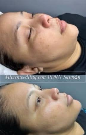 Suero rejuvenecedor con ADN de salmón PDRN - Image 3